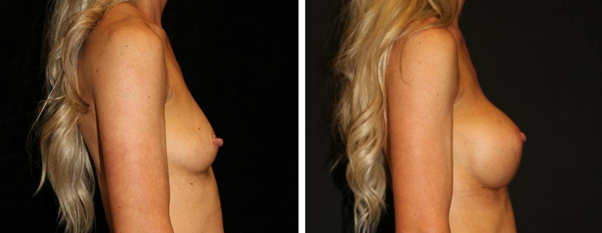 Breast Augmentation Before & After Gallery - Patient 254517 - Image 3
