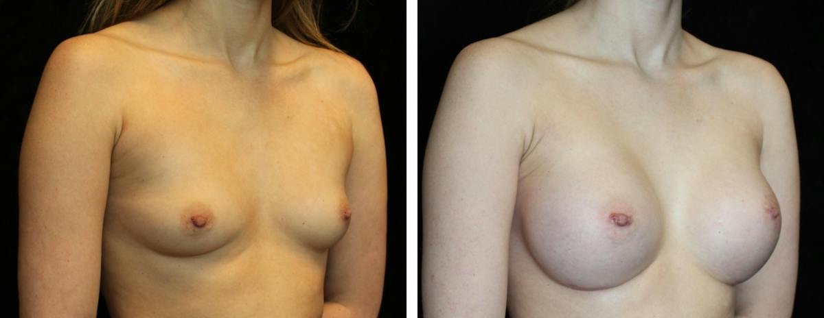 Breast Augmentation Before & After Gallery - Patient 334226 - Image 2