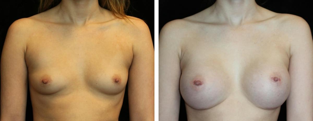 Breast Augmentation Before & After Gallery - Patient 334226 - Image 1