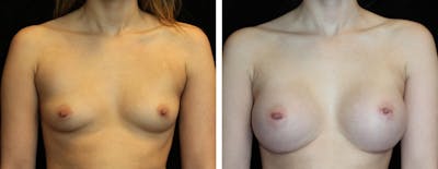 Breast Augmentation Before & After Gallery - Patient 334226 - Image 1
