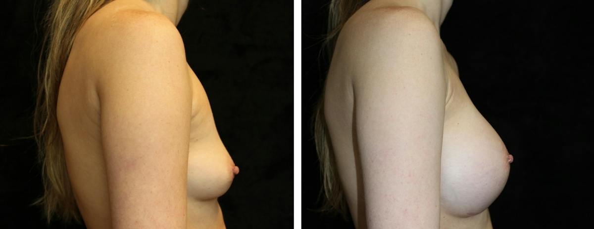 Breast Augmentation Before & After Gallery - Patient 334226 - Image 3