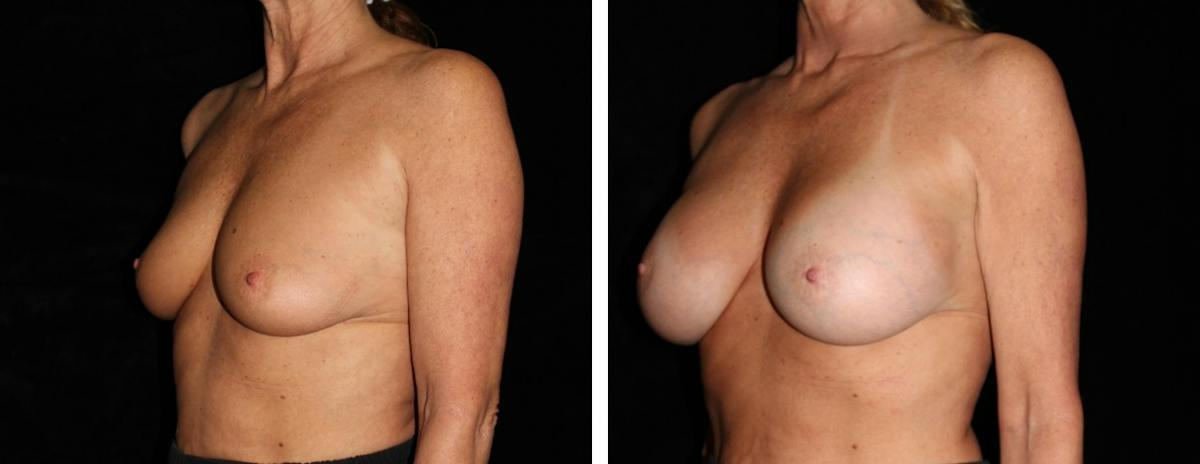 Breast Augmentation Before & After Gallery - Patient 525324 - Image 2