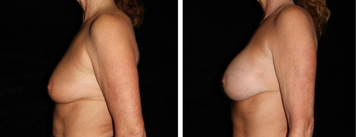 Breast Augmentation Before & After Gallery - Patient 525324 - Image 3