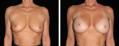 Breast Augmentation Before & After Gallery - Patient 525324 - Image 1