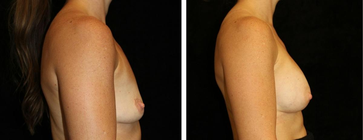 Breast Augmentation Before & After Gallery - Patient 121800 - Image 3