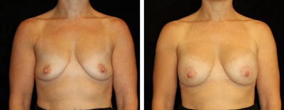 Breast Augmentation Before & After Gallery - Patient 121800 - Image 1