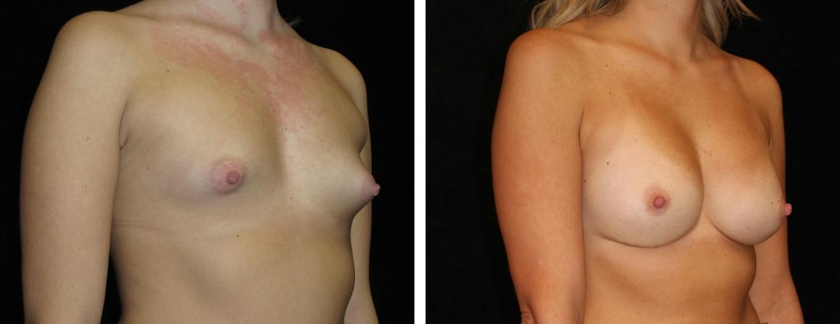 Breast Augmentation Before & After Gallery - Patient 267219 - Image 2