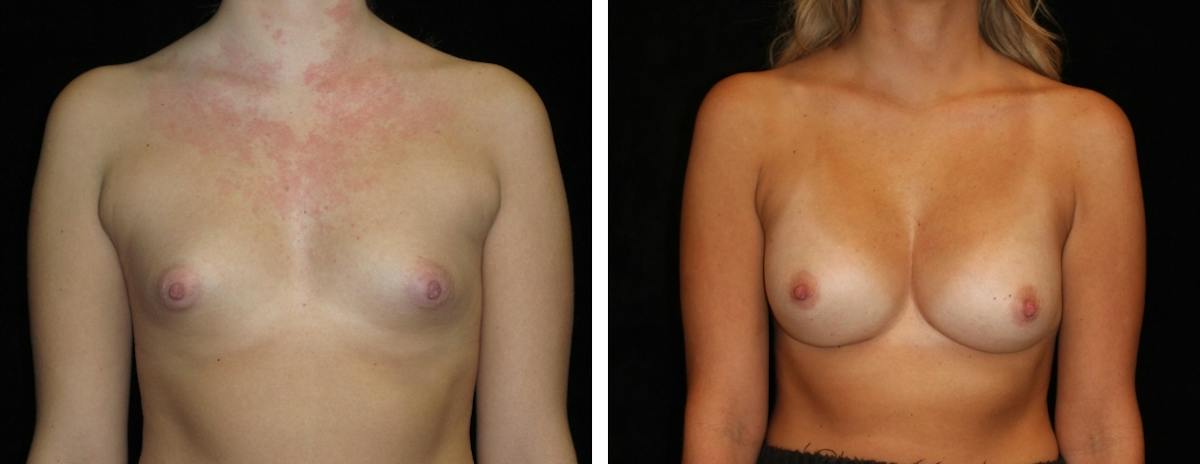 Breast Augmentation Before & After Gallery - Patient 267219 - Image 1