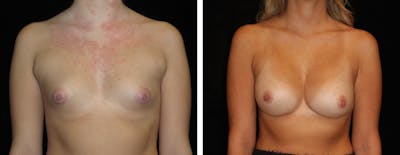 Breast Augmentation Before & After Gallery - Patient 267219 - Image 1