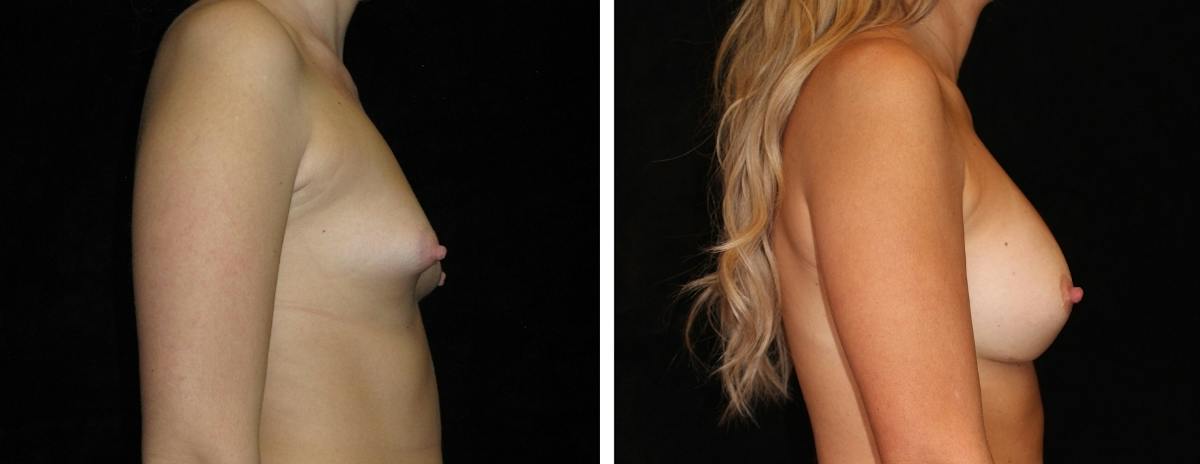 Breast Augmentation Before & After Gallery - Patient 267219 - Image 3