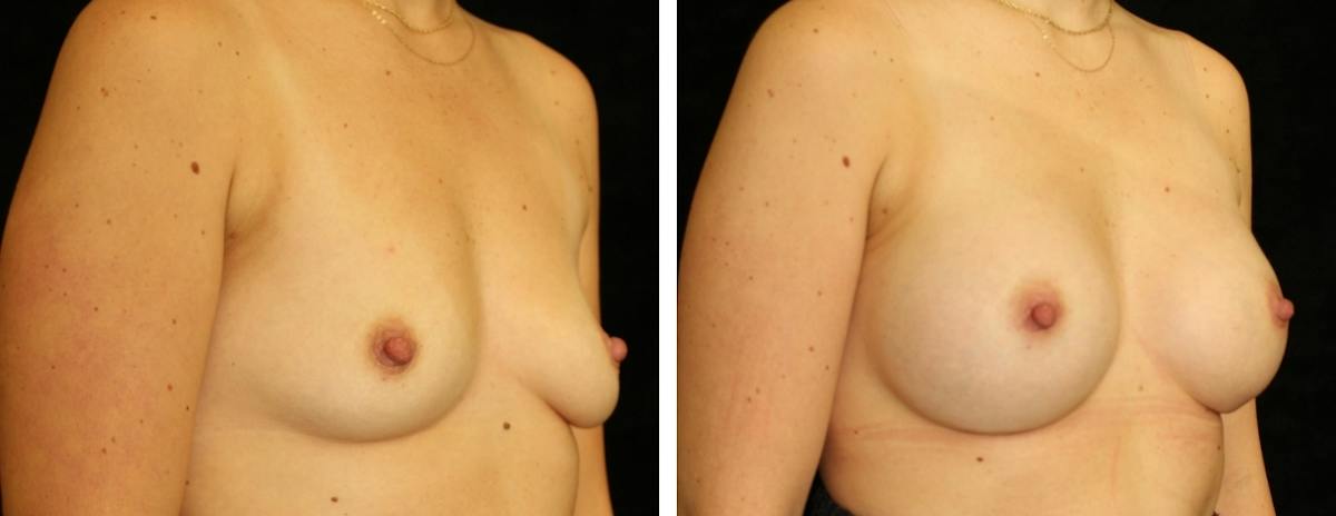 Breast Augmentation Before & After Gallery - Patient 587445 - Image 2