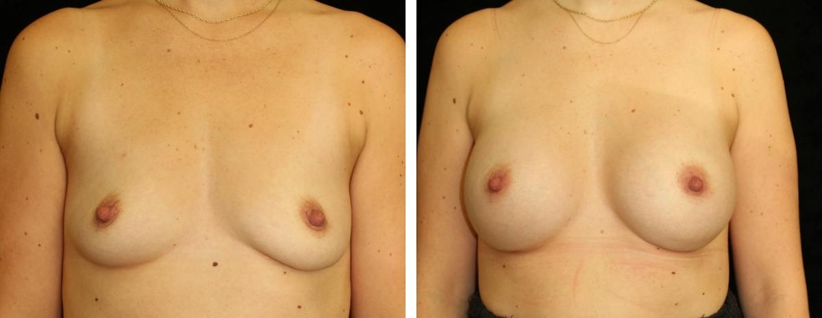 Breast Augmentation Before & After Gallery - Patient 587445 - Image 1