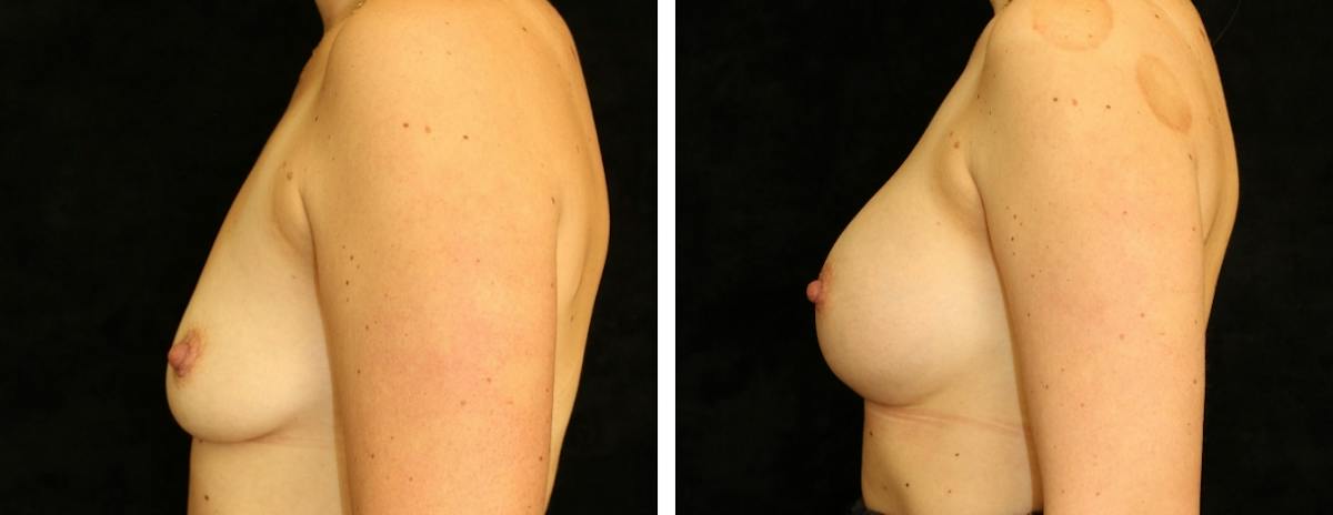 Breast Augmentation Before & After Gallery - Patient 587445 - Image 3