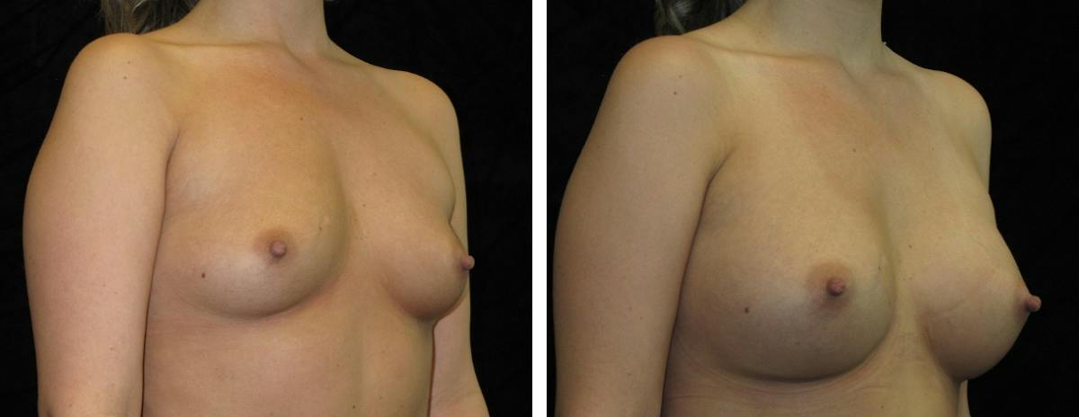 Breast Augmentation Before & After Gallery - Patient 382442 - Image 2