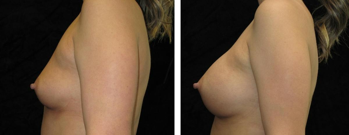 Breast Augmentation Before & After Gallery - Patient 382442 - Image 3