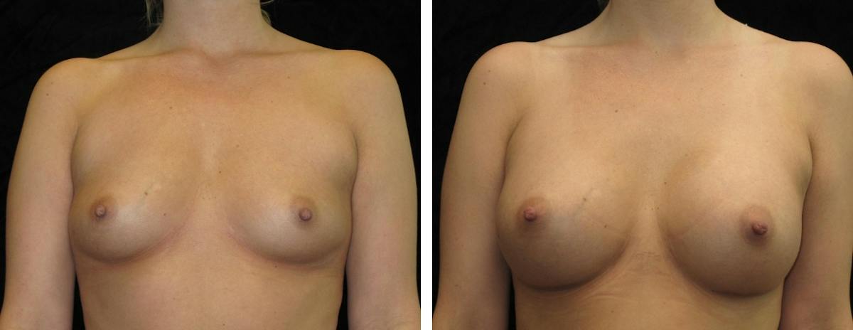 Breast Augmentation Before & After Gallery - Patient 382442 - Image 1