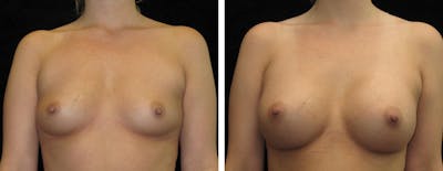 Breast Augmentation Before & After Gallery - Patient 382442 - Image 1