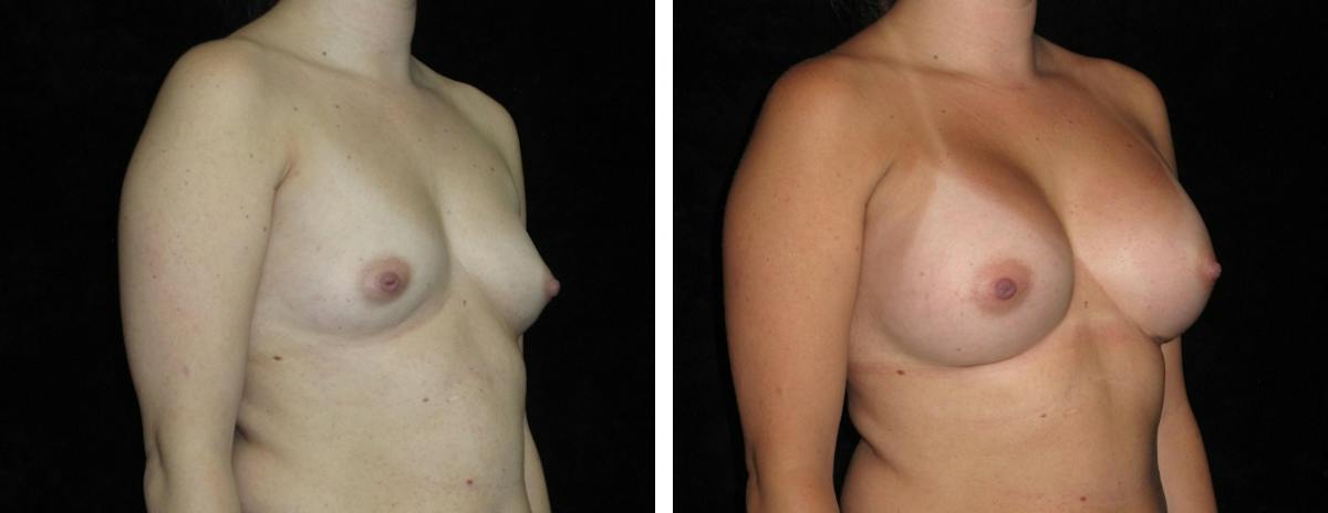Breast Augmentation Before & After Gallery - Patient 418524 - Image 2