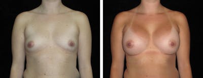 Breast Augmentation Before & After Gallery - Patient 418524 - Image 1