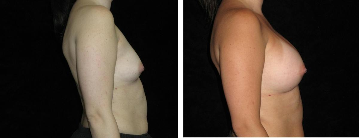 Breast Augmentation Before & After Gallery - Patient 418524 - Image 3