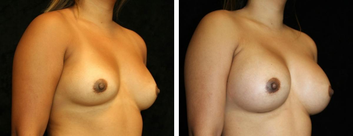 Breast Augmentation Before & After Gallery - Patient 164746 - Image 2