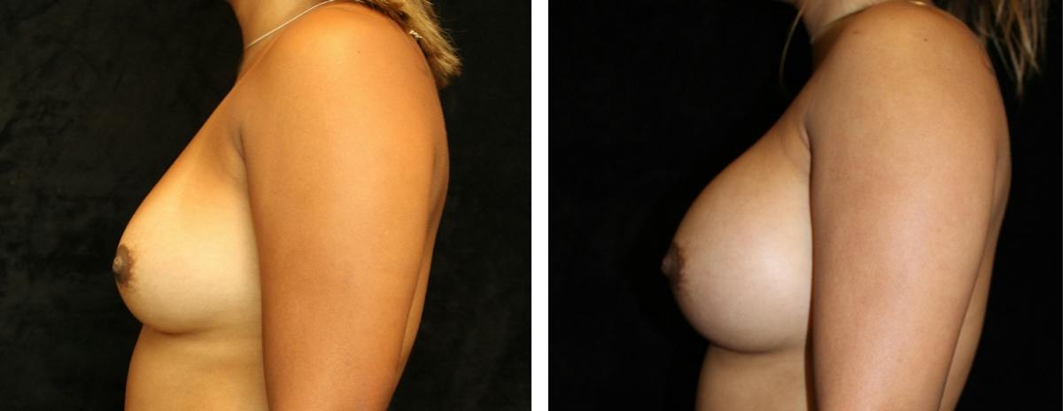 Breast Augmentation Before & After Gallery - Patient 164746 - Image 3