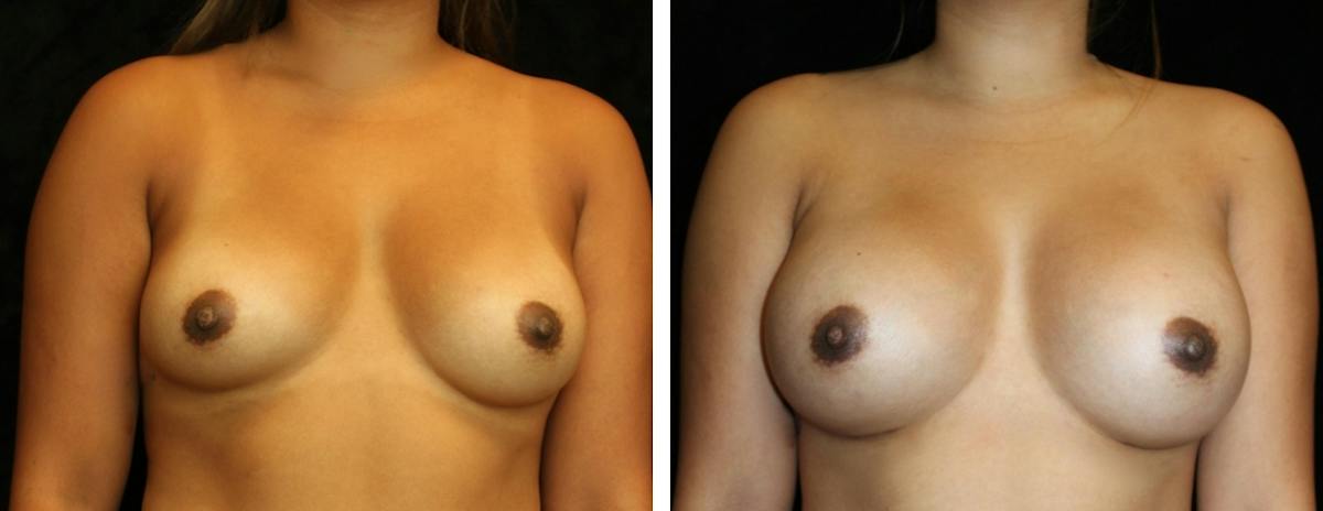 Breast Augmentation Before & After Gallery - Patient 164746 - Image 1