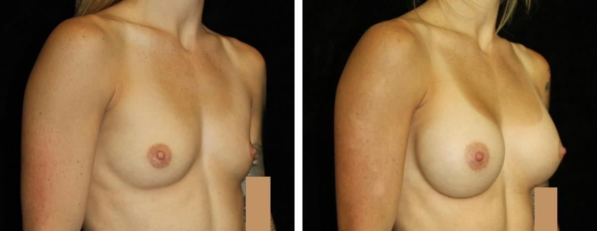 Breast Augmentation Before & After Gallery - Patient 103111 - Image 2