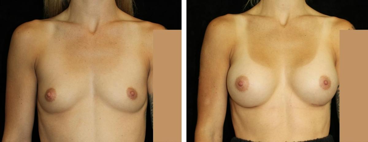 Breast Augmentation Before & After Gallery - Patient 103111 - Image 1