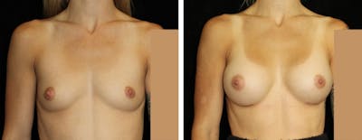 Breast Augmentation Before & After Gallery - Patient 103111 - Image 1