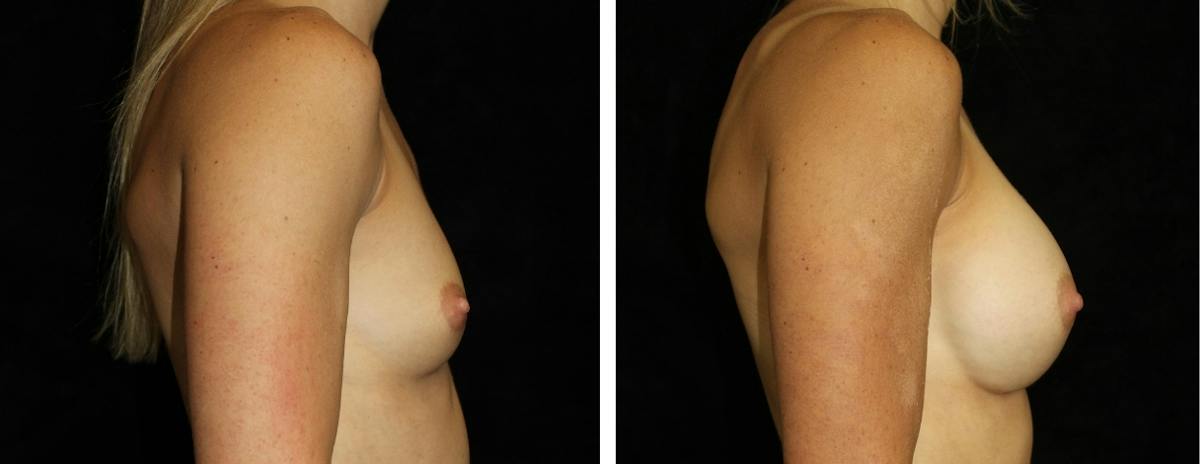 Breast Augmentation Before & After Gallery - Patient 103111 - Image 3