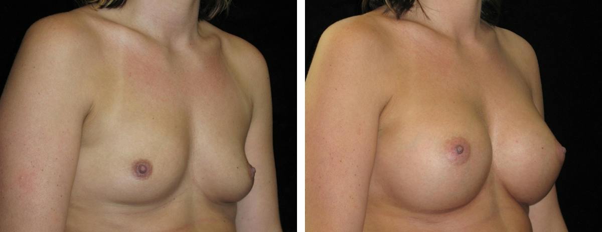 Breast Augmentation Before & After Gallery - Patient 862897 - Image 2