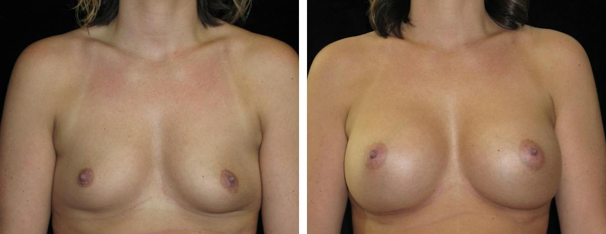 Breast Augmentation Before & After Gallery - Patient 862897 - Image 1