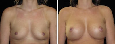 Breast Augmentation Before & After Gallery - Patient 862897 - Image 1