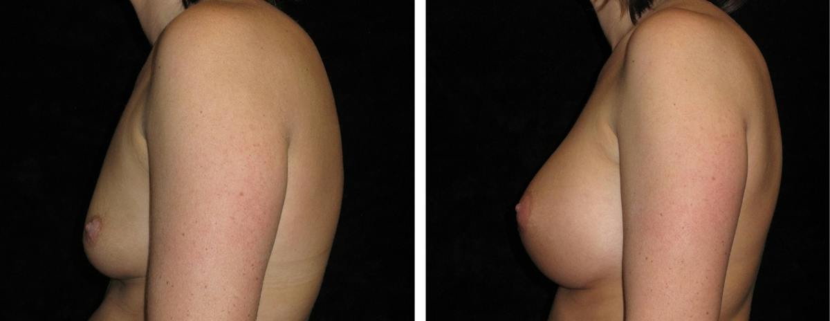 Breast Augmentation Before & After Gallery - Patient 862897 - Image 3
