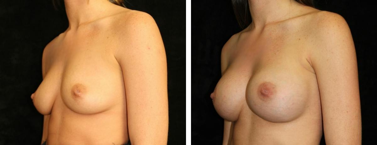 Breast Augmentation Before & After Gallery - Patient 432891 - Image 2