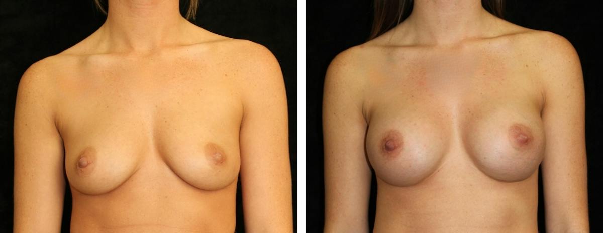 Breast Augmentation Before & After Gallery - Patient 432891 - Image 1