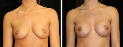 Breast Augmentation Before & After Gallery - Patient 432891 - Image 1