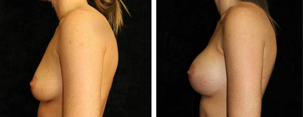 Breast Augmentation Before & After Gallery - Patient 432891 - Image 3