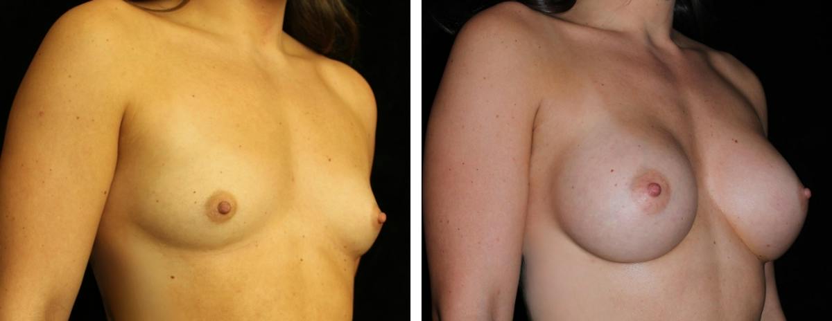 Breast Augmentation Before & After Gallery - Patient 301166 - Image 2
