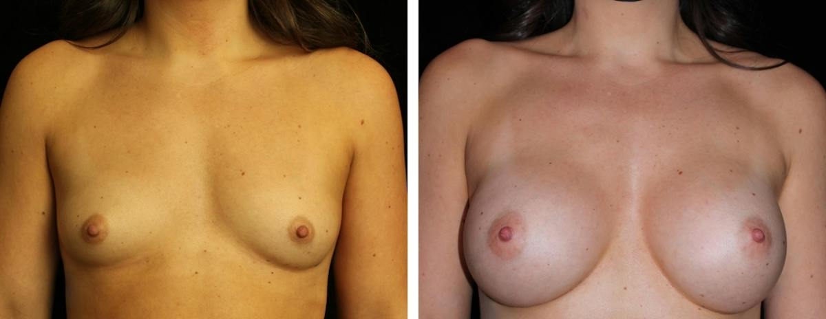 Breast Augmentation Before & After Gallery - Patient 301166 - Image 1
