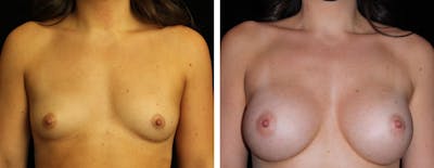 Breast Augmentation Before & After Gallery - Patient 301166 - Image 1