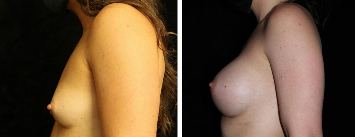 Breast Augmentation Before & After Gallery - Patient 301166 - Image 3