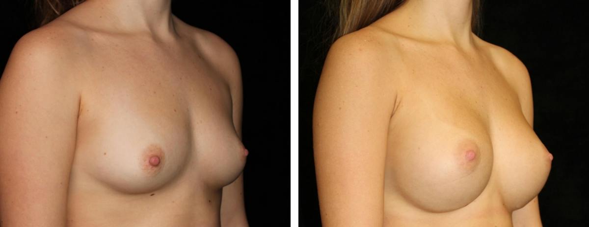 Breast Augmentation Before & After Gallery - Patient 165646 - Image 2