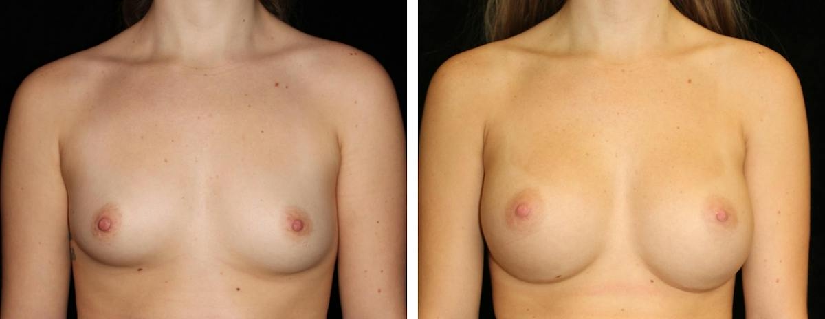 Breast Augmentation Before & After Gallery - Patient 165646 - Image 1