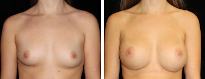 Breast Augmentation Before & After Gallery - Patient 165646 - Image 1