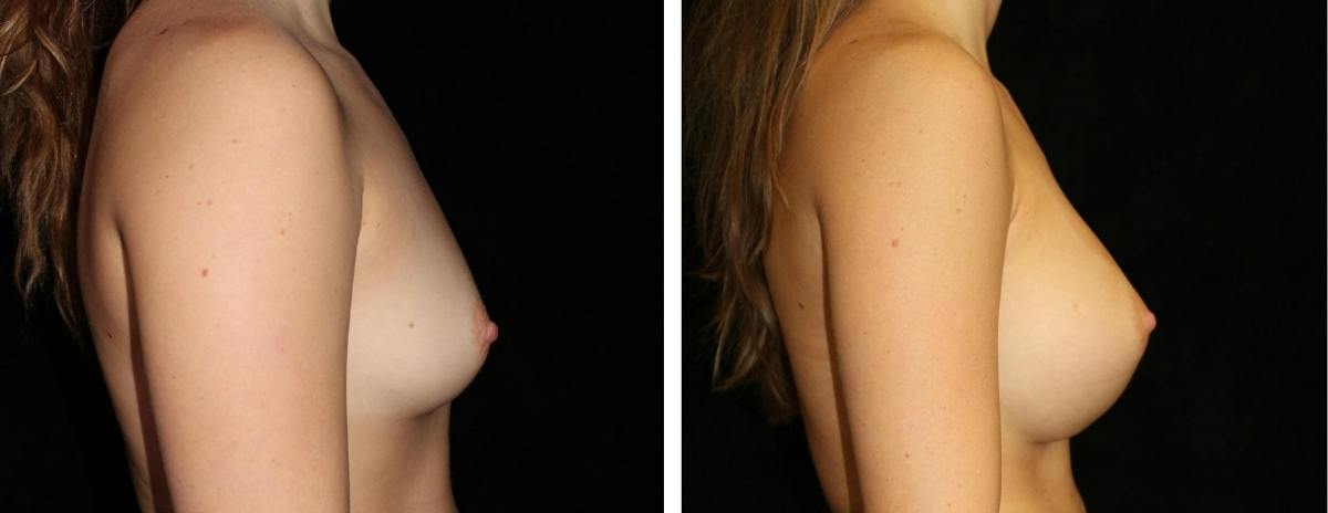 Breast Augmentation Before & After Gallery - Patient 165646 - Image 3