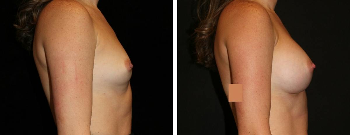 Breast Augmentation Before & After Gallery - Patient 249616 - Image 3