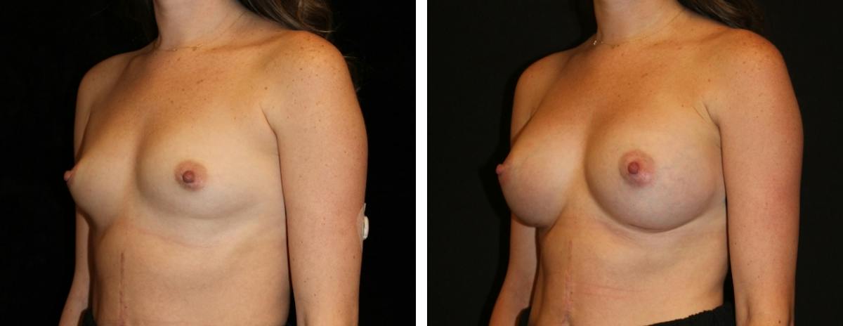 Breast Augmentation Before & After Gallery - Patient 249616 - Image 2