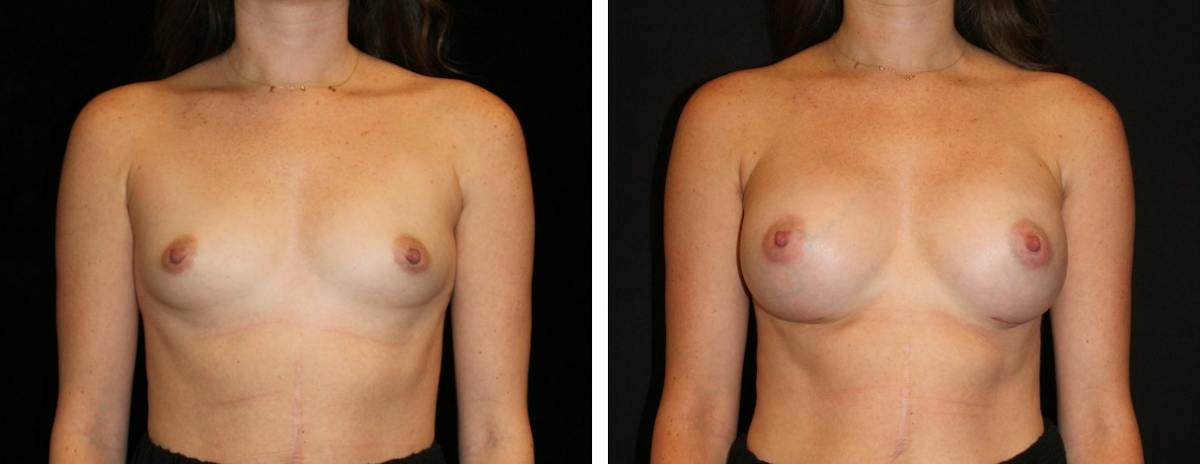 Breast Augmentation Before & After Gallery - Patient 249616 - Image 1